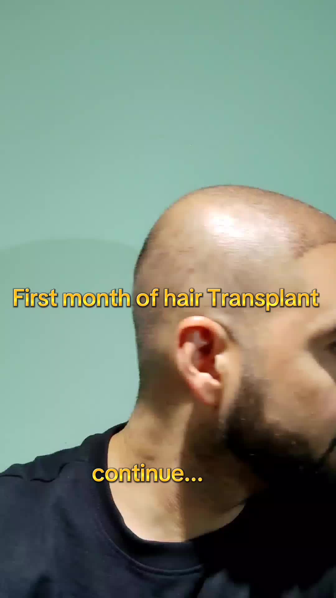 @My hair transplant