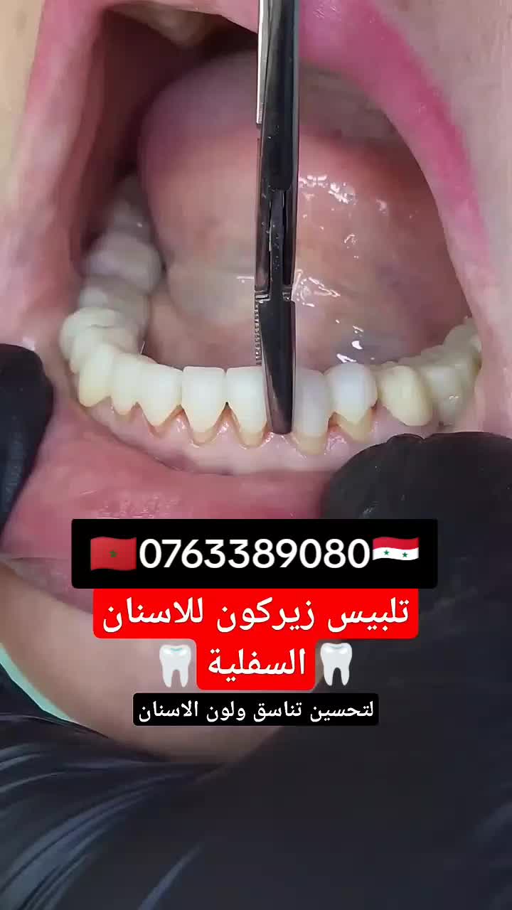 @تركيب الاسنان 🇸🇾🇲🇦🦷 سوري