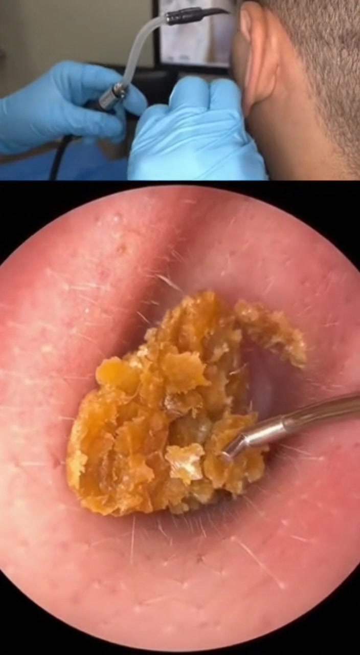 @Ear Cleaning