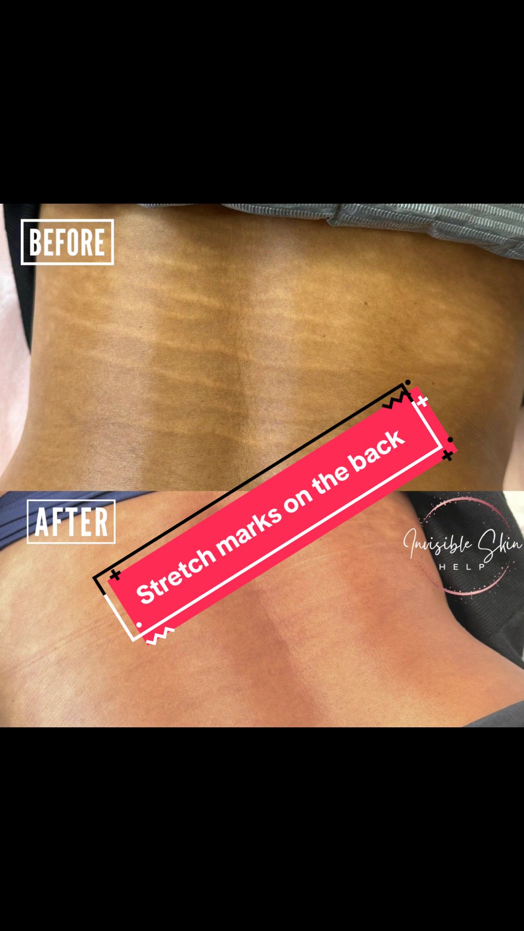 @Invisibleskinhelp