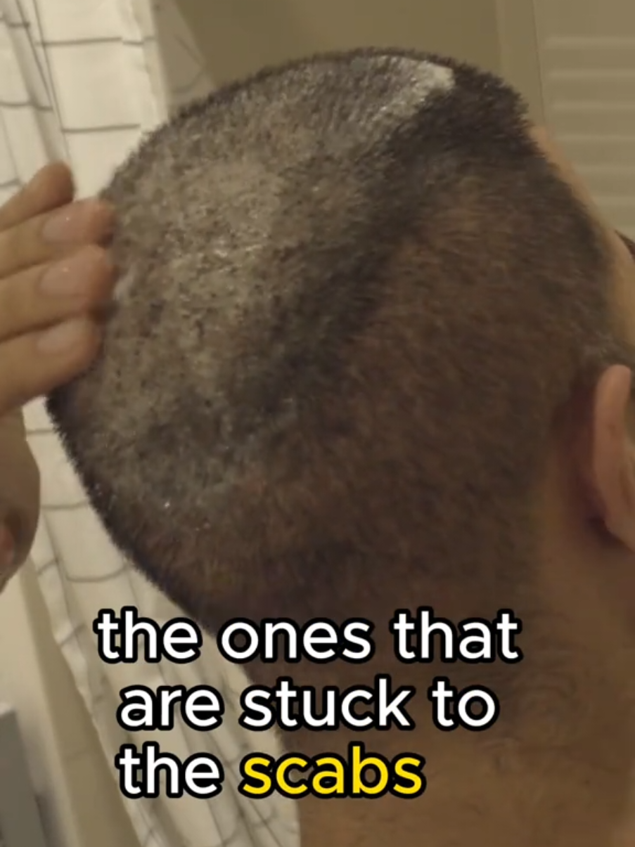 @Amit | Hair Transplant Tips