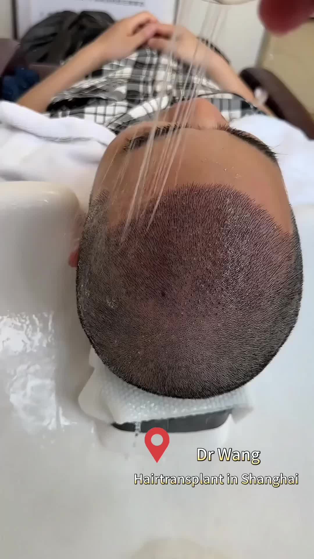 @HAIR TRANSPLANT WANG🇨🇳