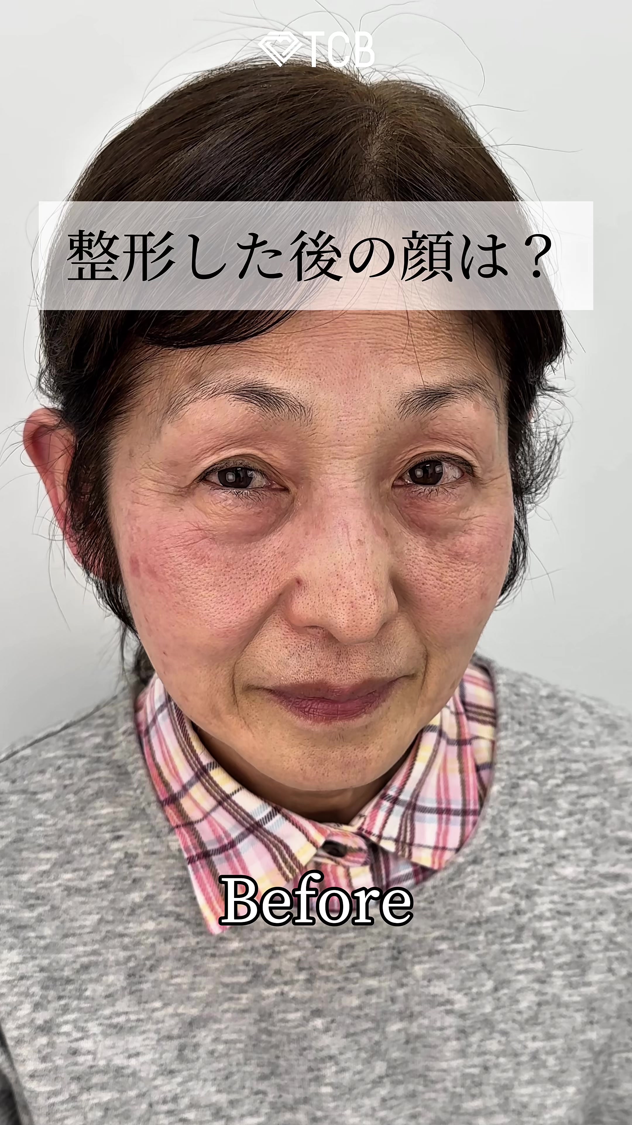 @【二重整形/糸リフト】TCB京都駅前院 橋本晋太朗