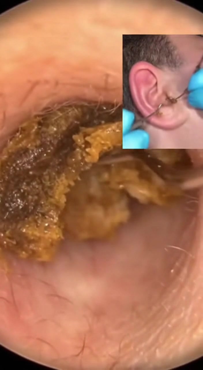 @Ear Cleaning