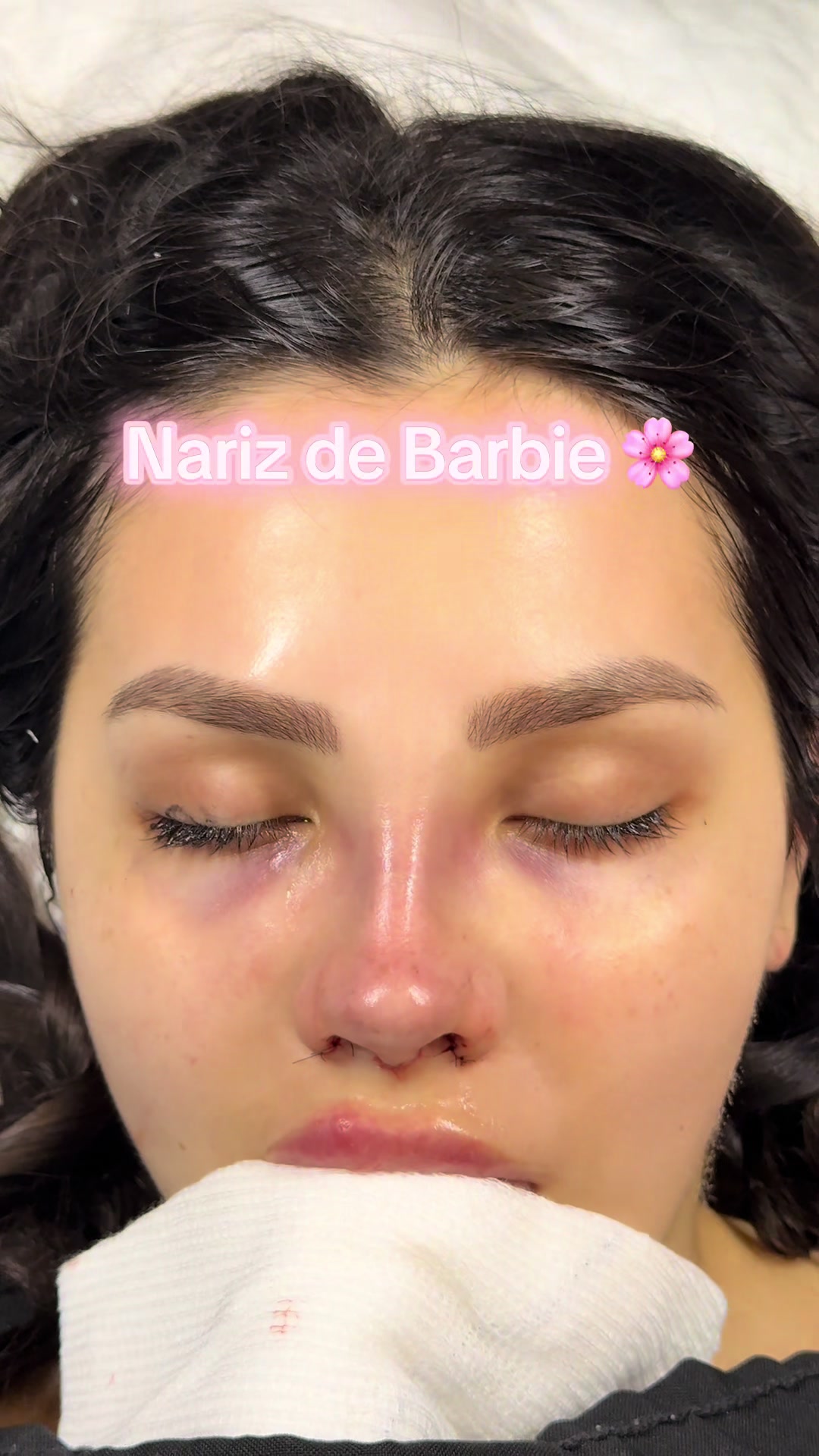 @drgarone.rinoplastia