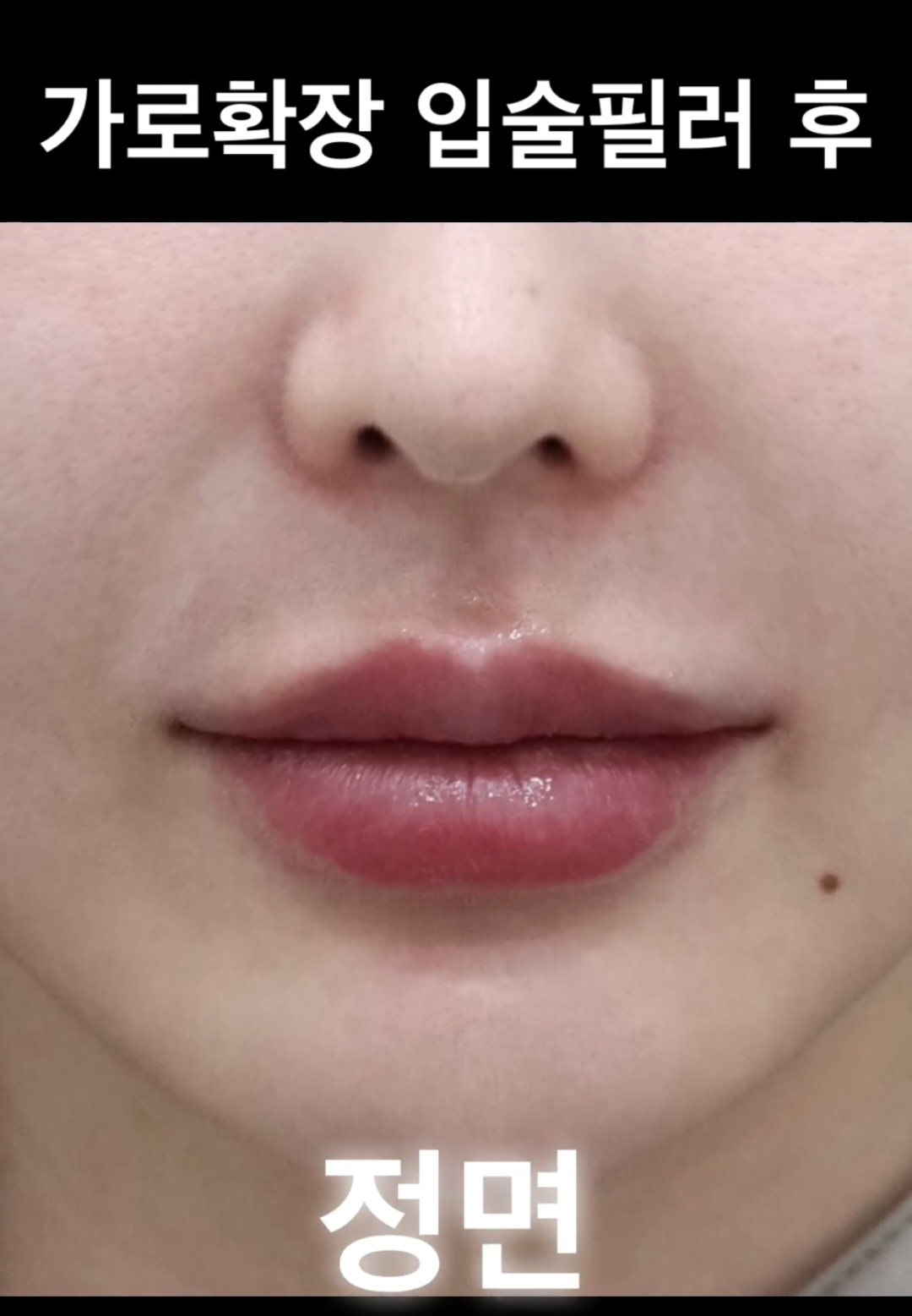 @금손닥터 이현주 Dr.GOLD_FILLER