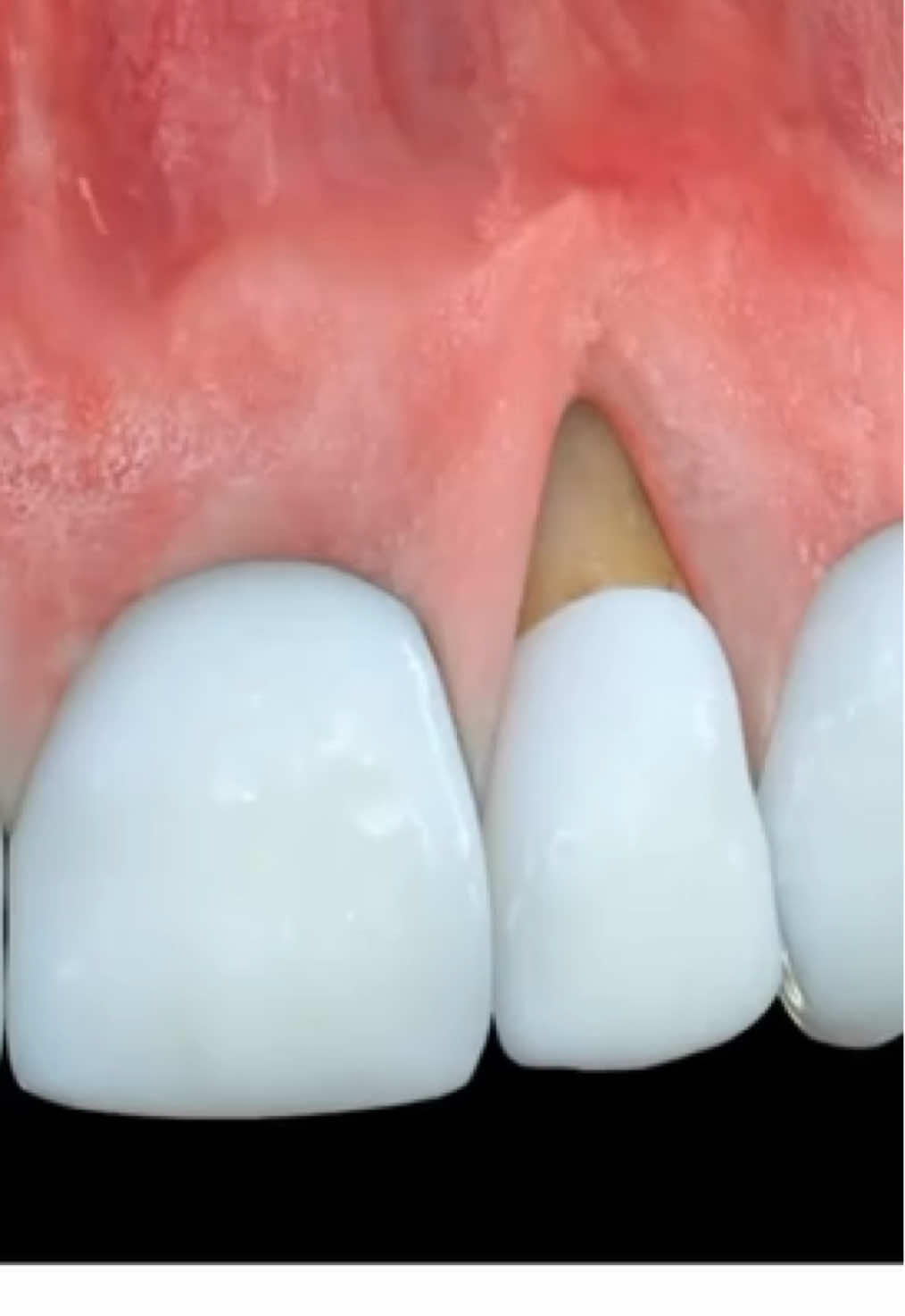 @Dent_tooth