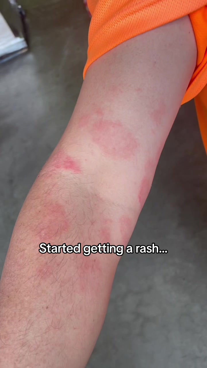 @Eczema Diaries USA & UK