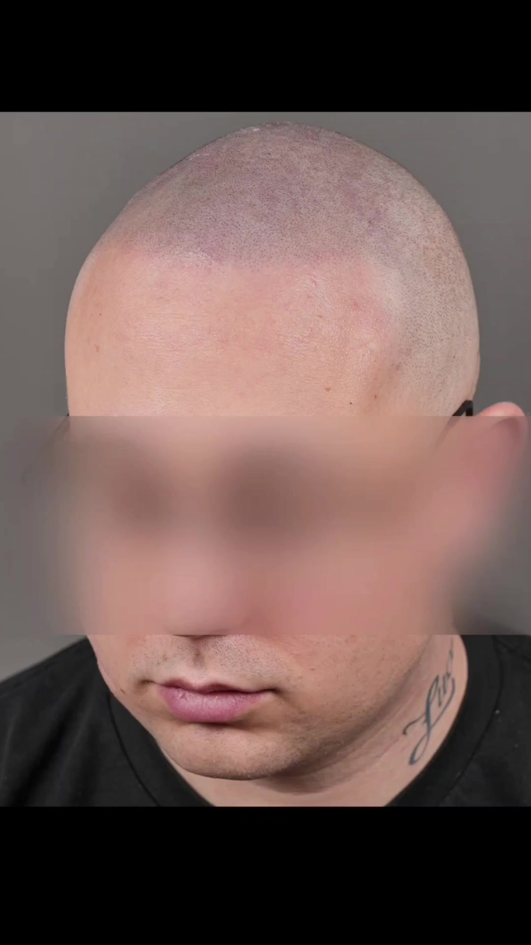 @Enhanced Scalp