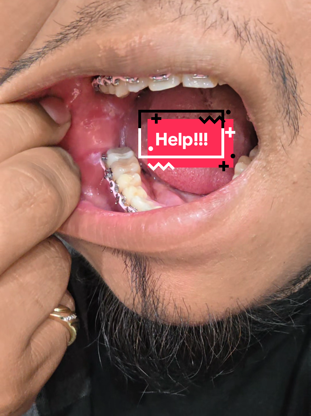 @str8braces