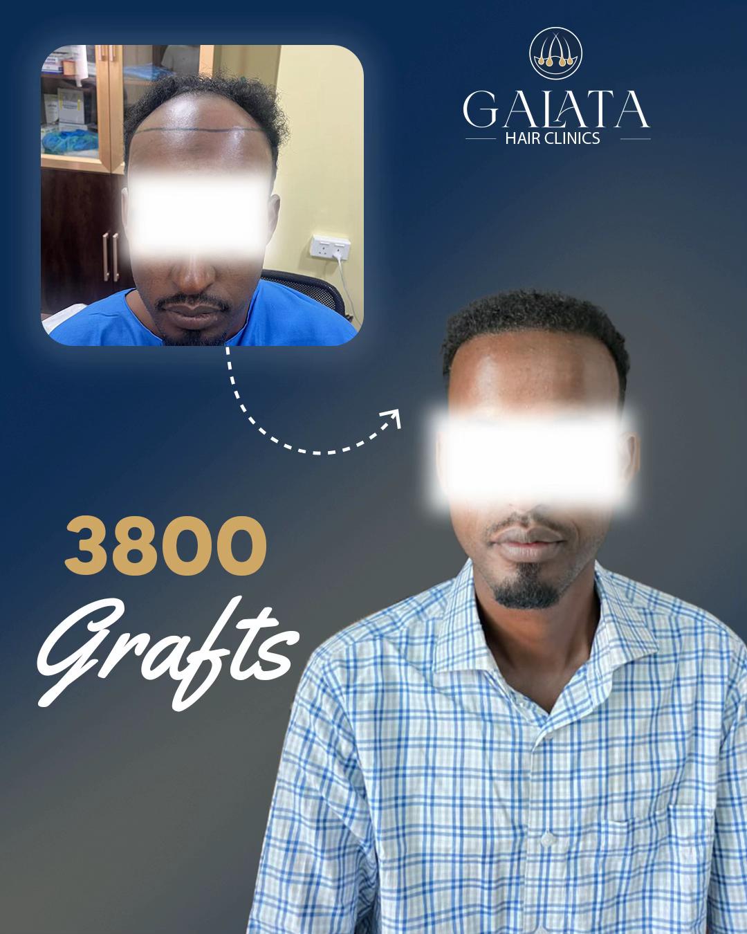 @galata_hair_clinic