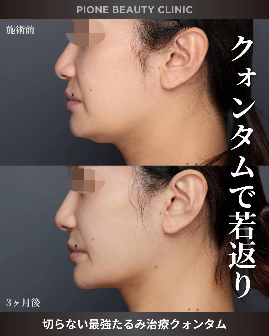 @金澤紀臣【小顔/若返り/脂肪吸引】