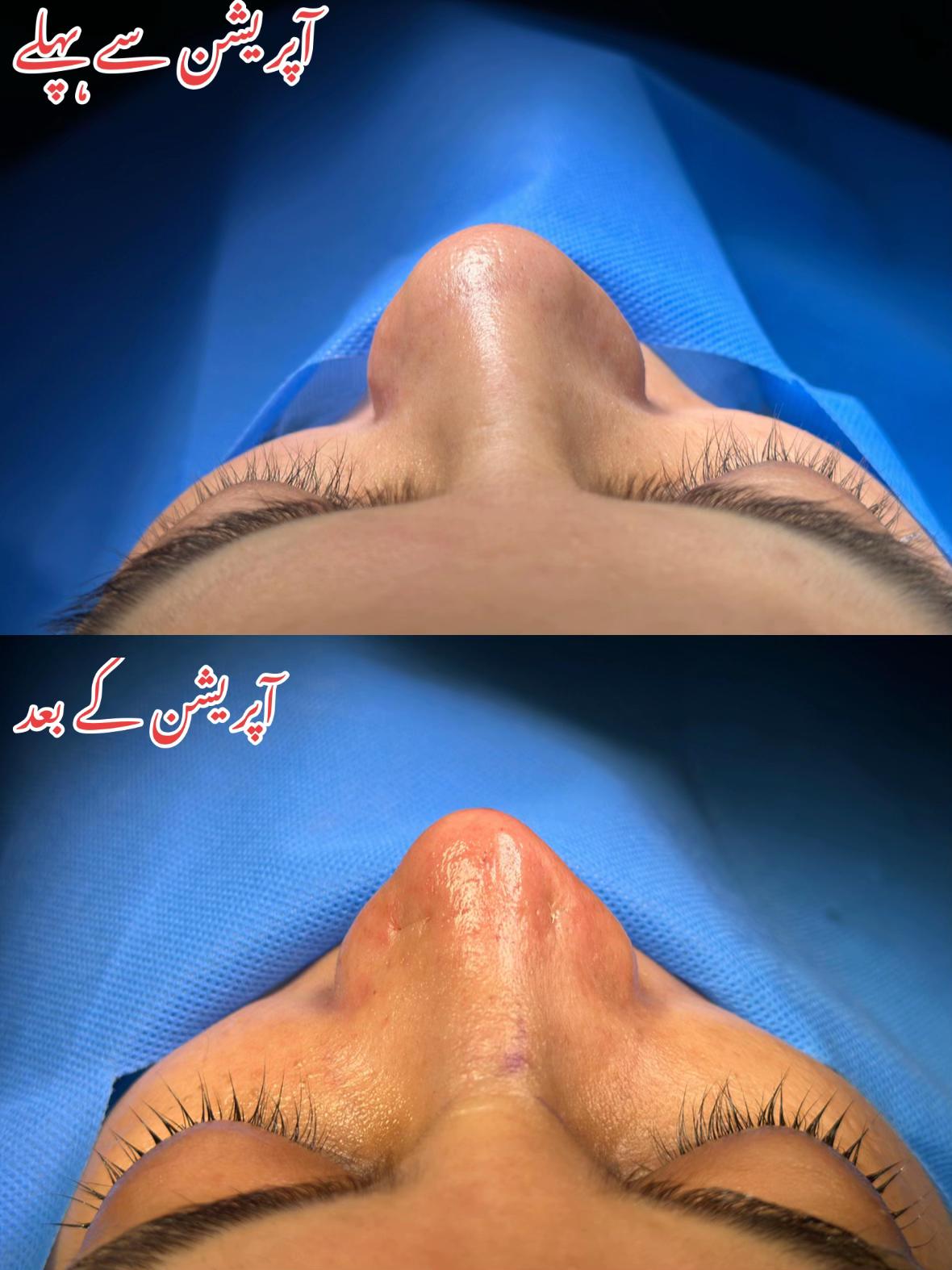 @Rhinoplastyhub clinic222