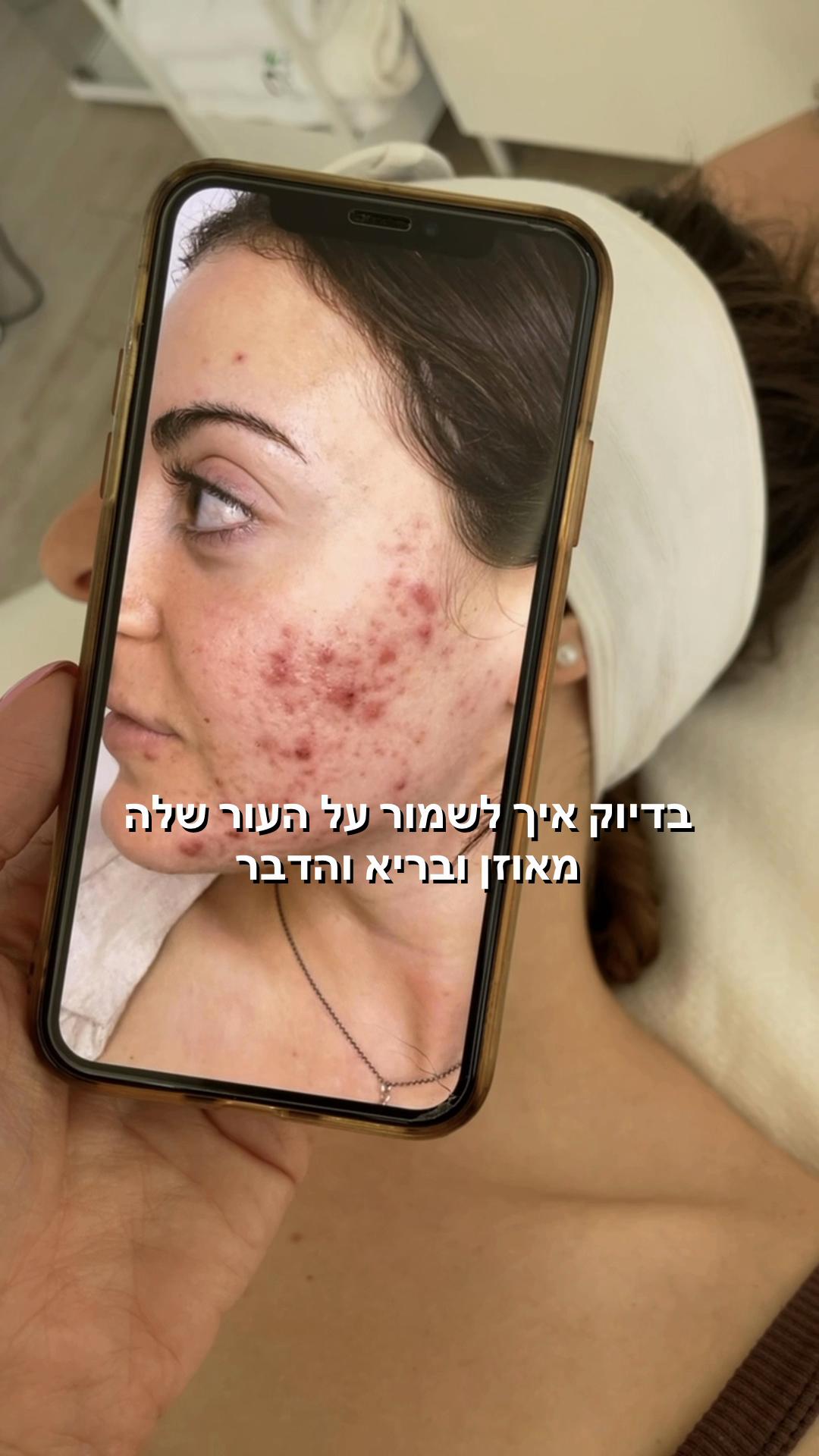 @תמר זריבץ - אקנה ופוסט אקנה