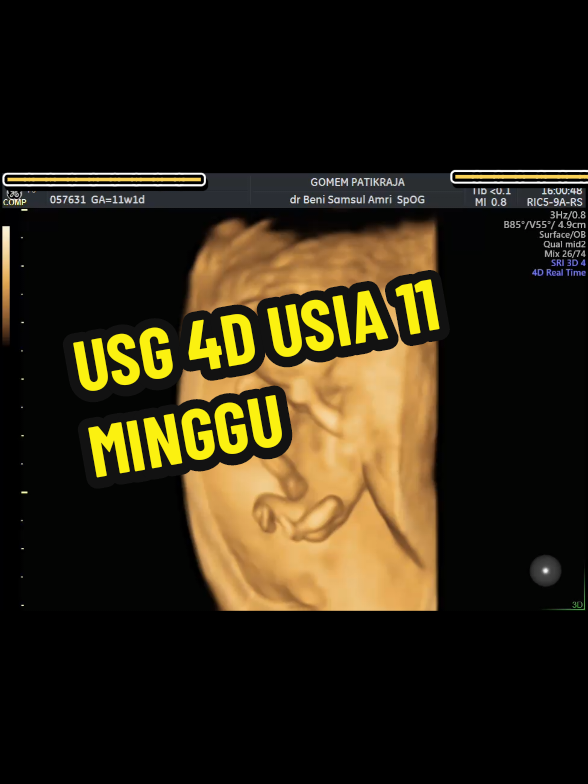 @USG 4D PURWOKERTO