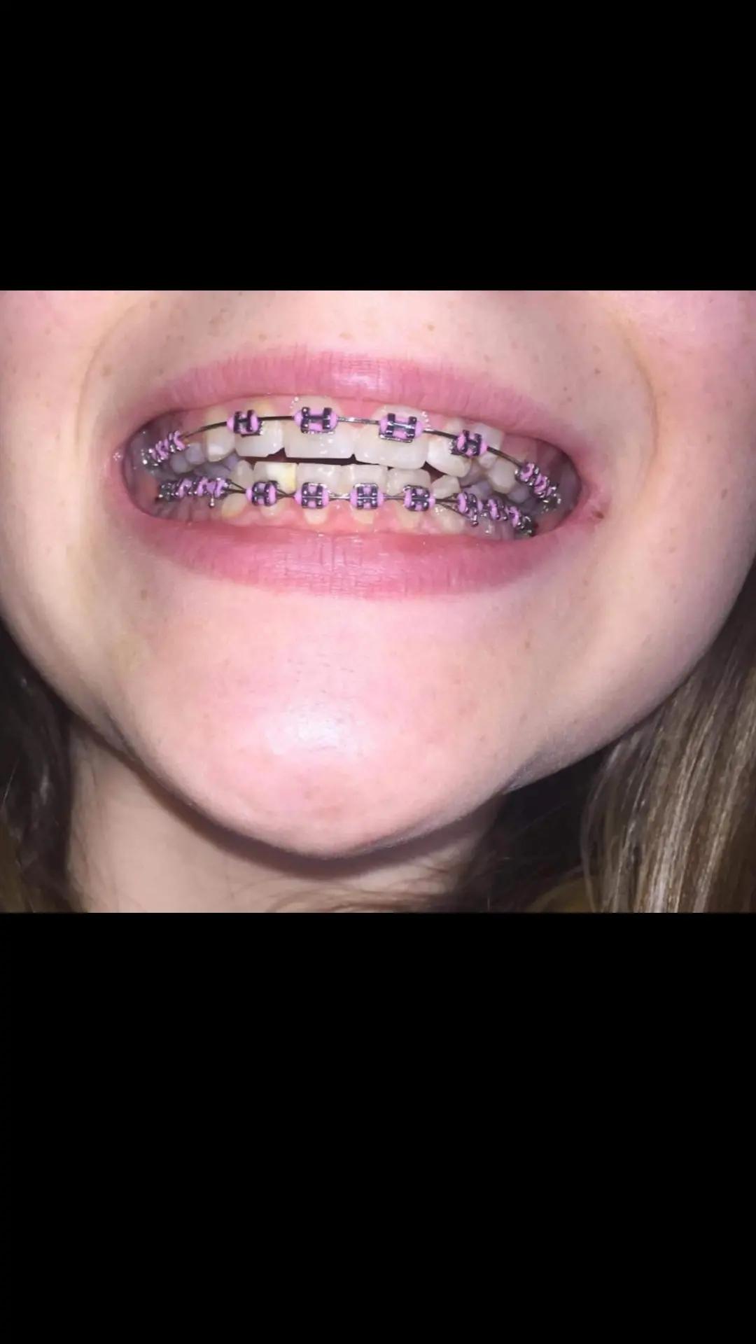 @Zahnspangen Club/  Braces Site