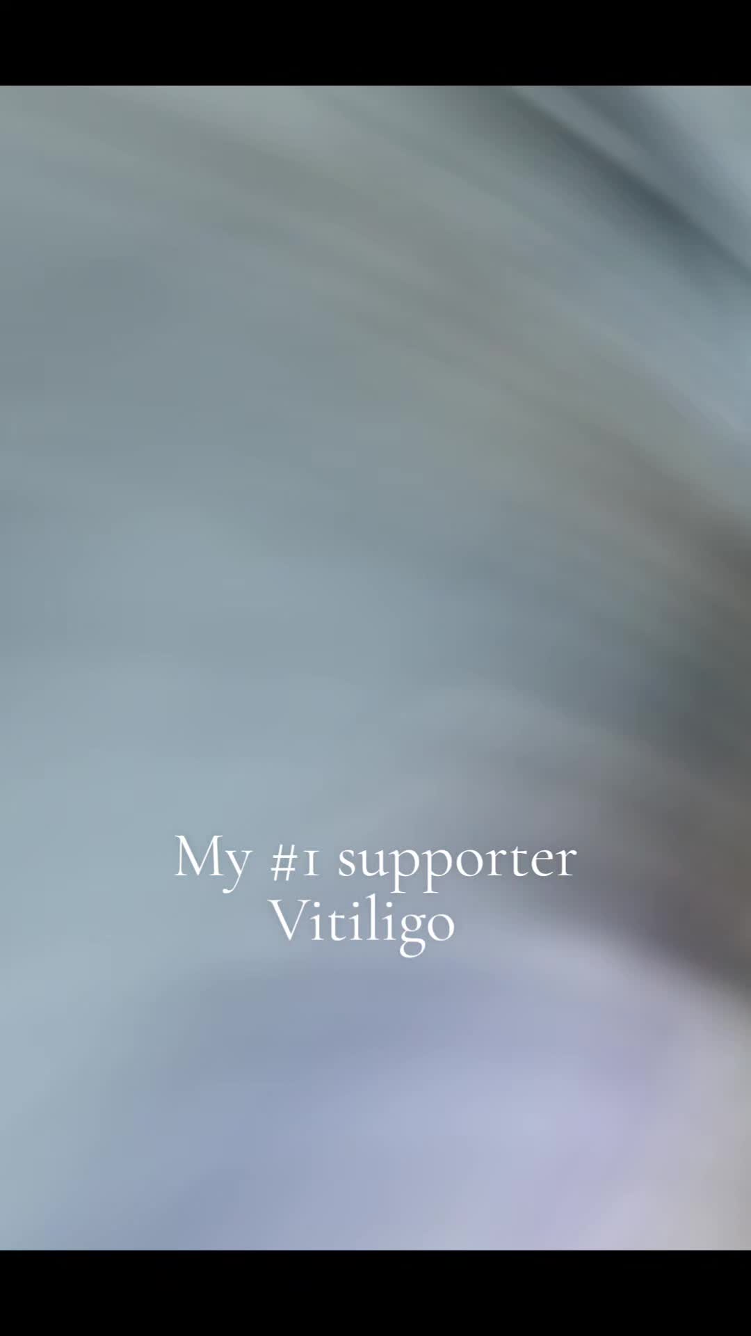 @Miss. PinkY(vitiligo girl)