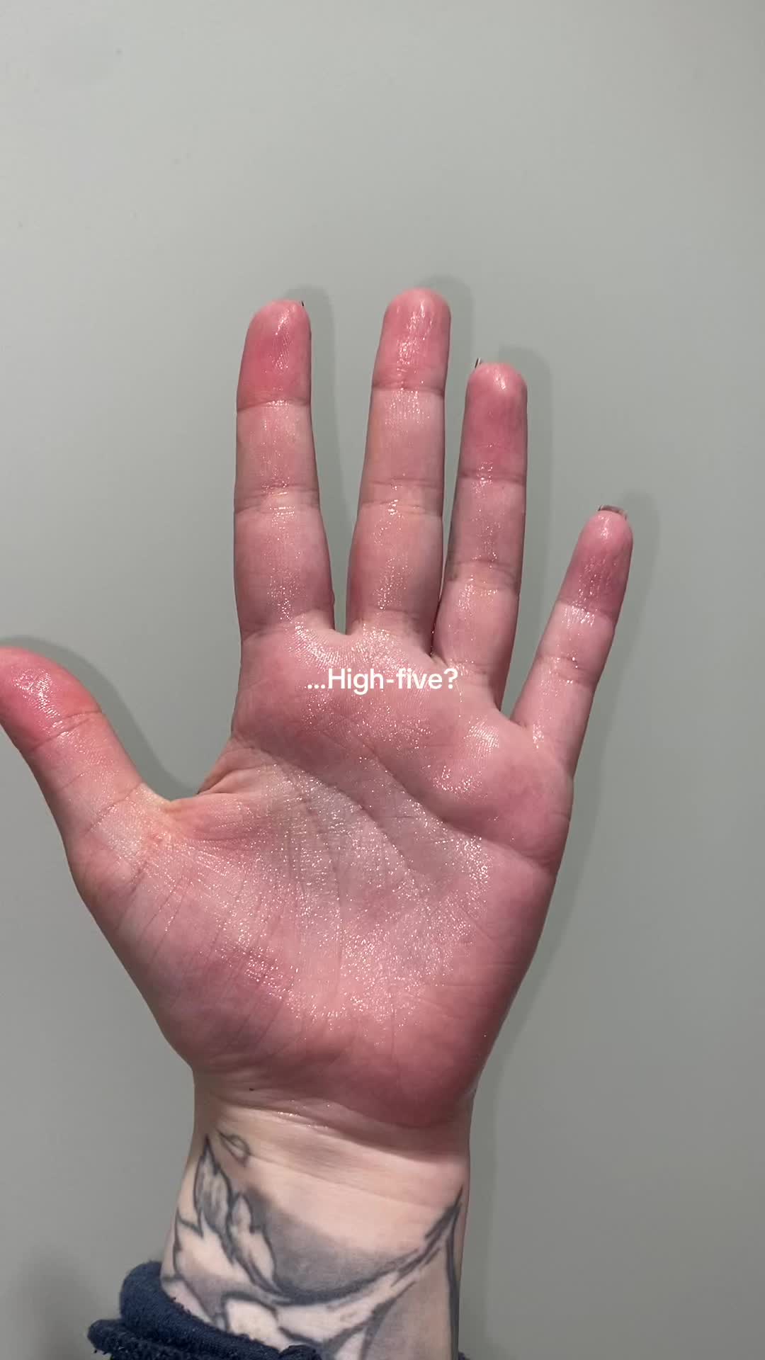 @LivingWithHyperhidrosis