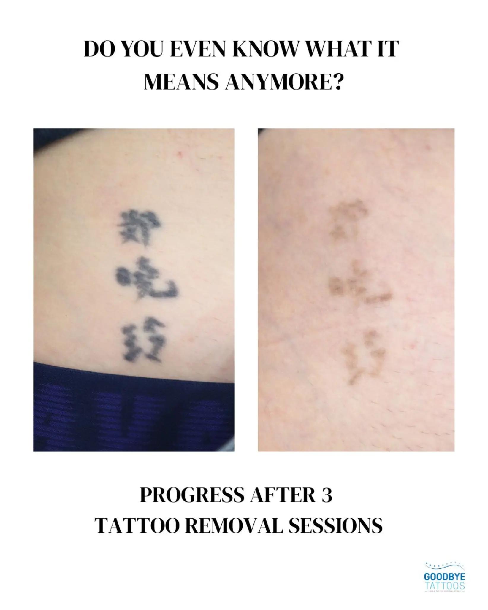 @Jamie T| Tattoo Removal Expert