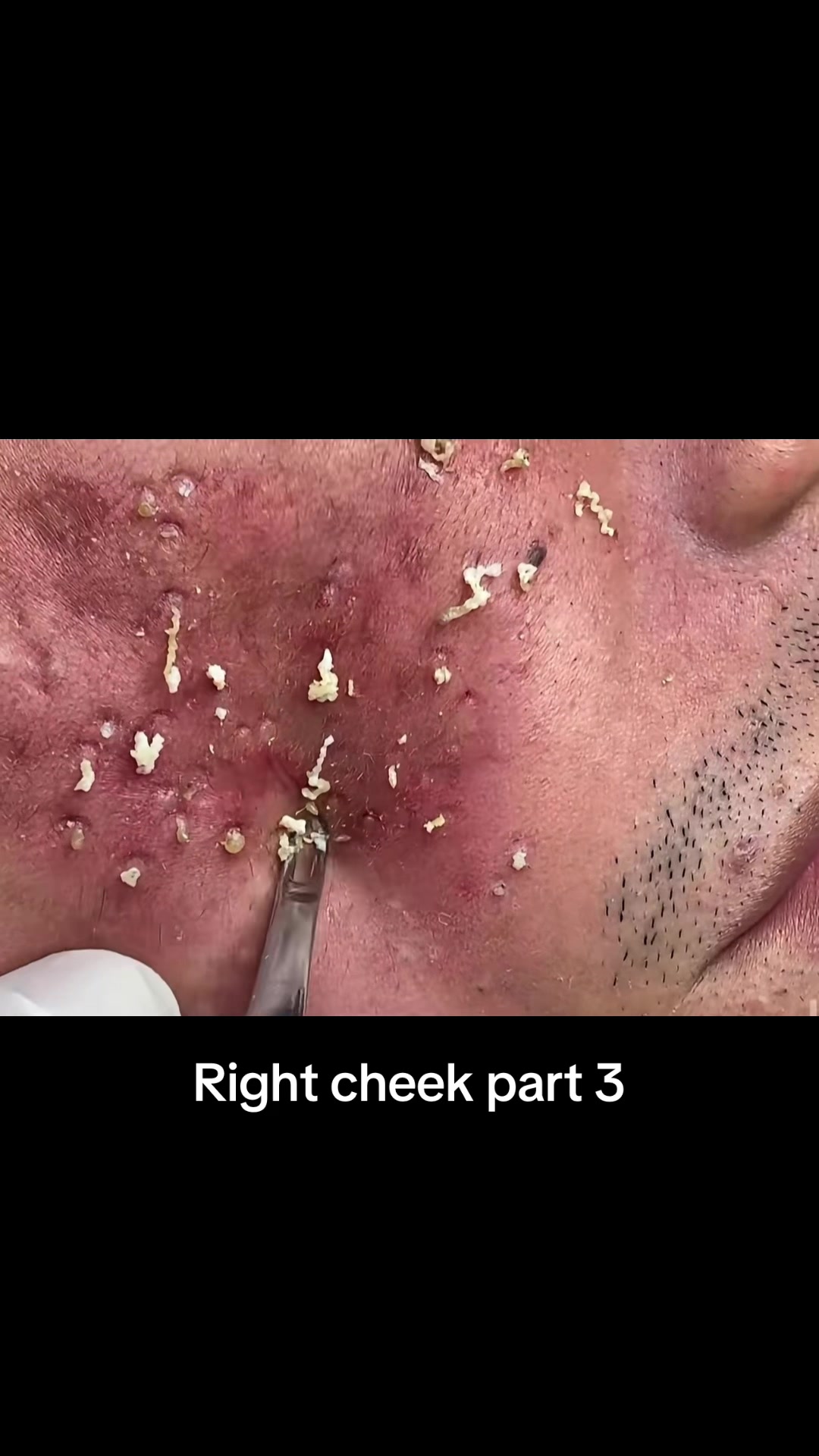 @pimplepopperasmr