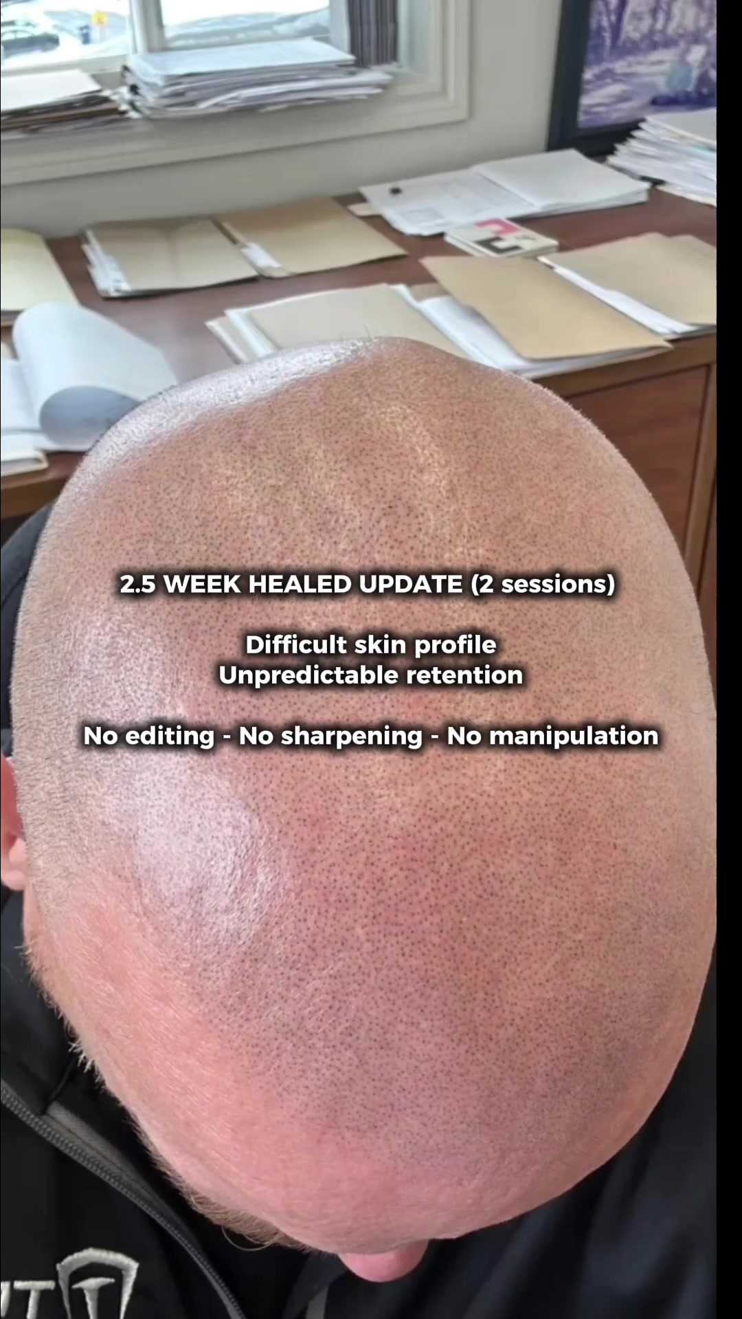 @Enhanced Scalp