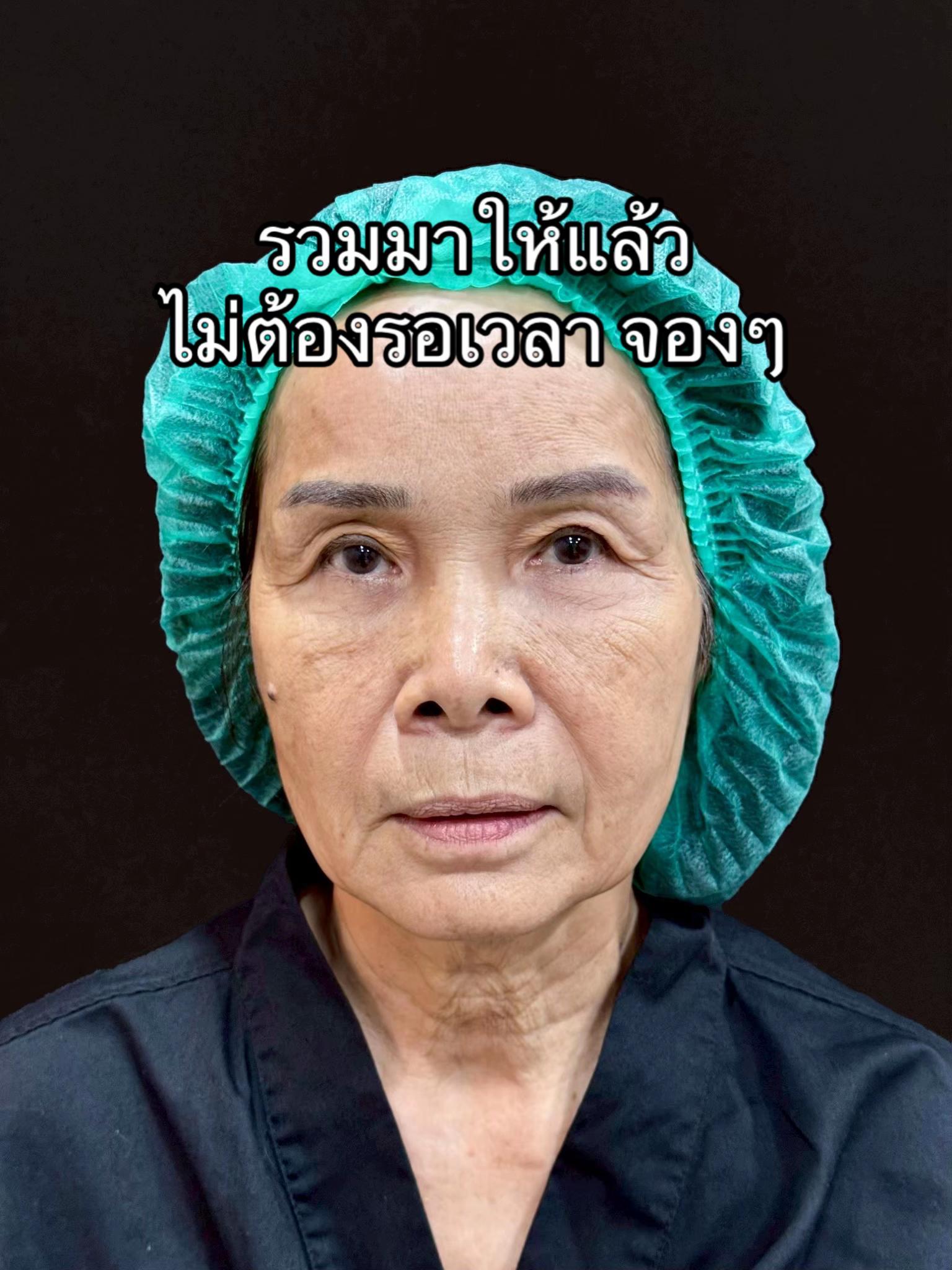 @ดึงหน้า ud clinic