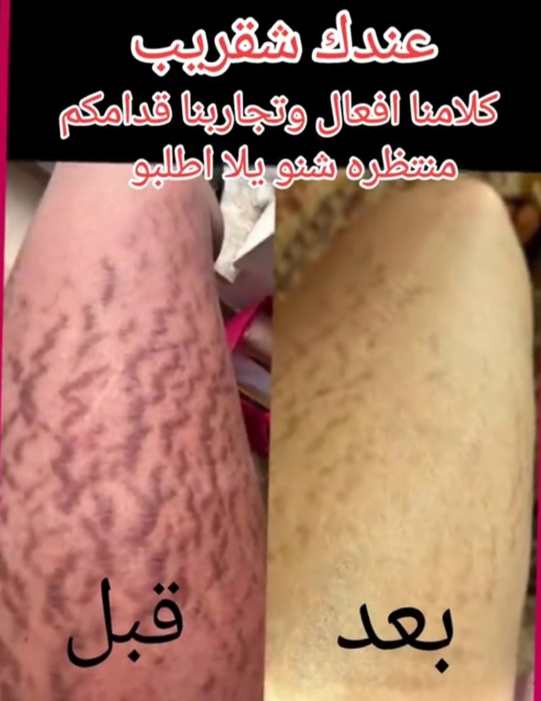 @drmanal  " لعلاج التشققات "