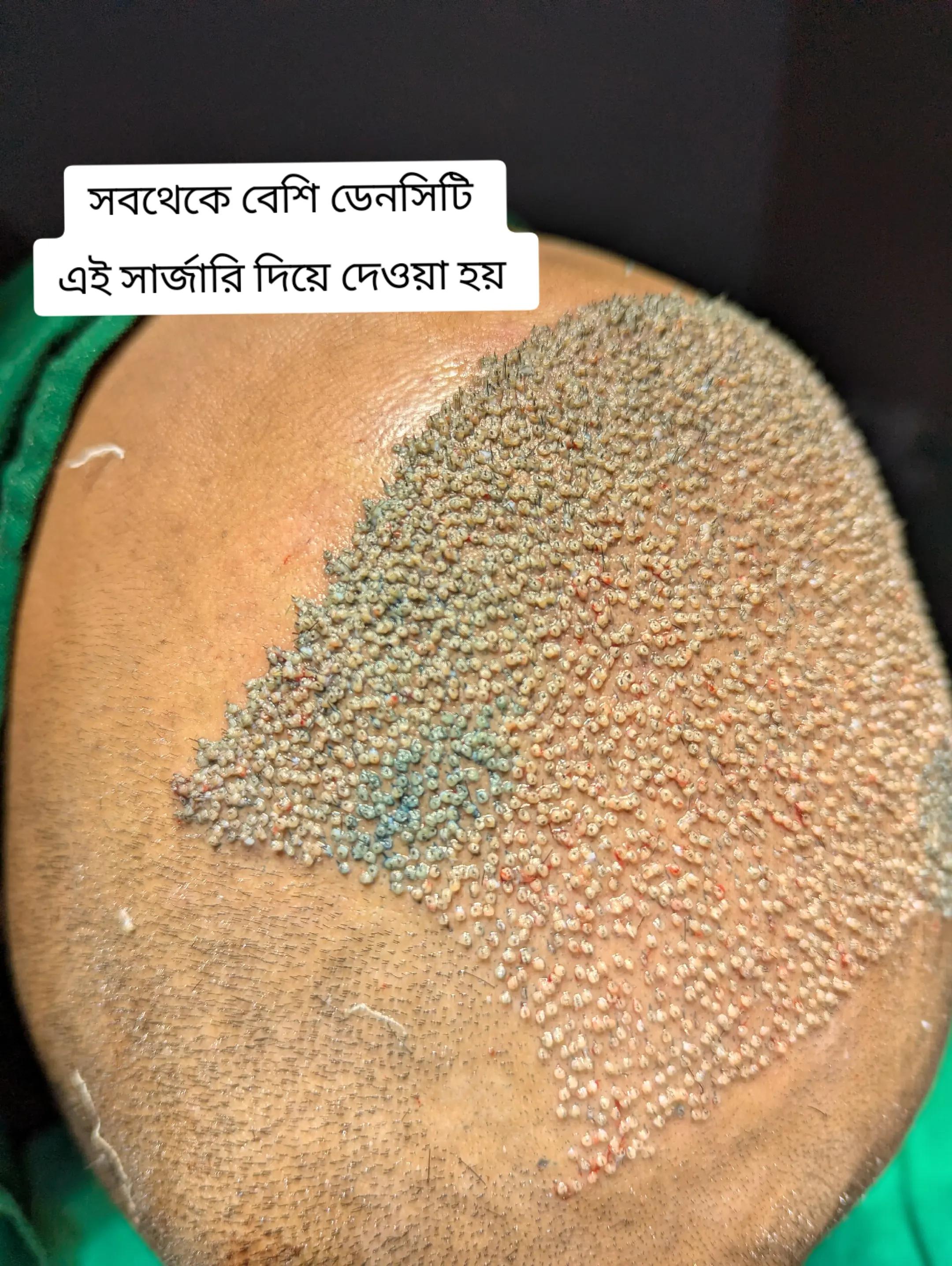 @NAZID HAIR TRANSPLANT