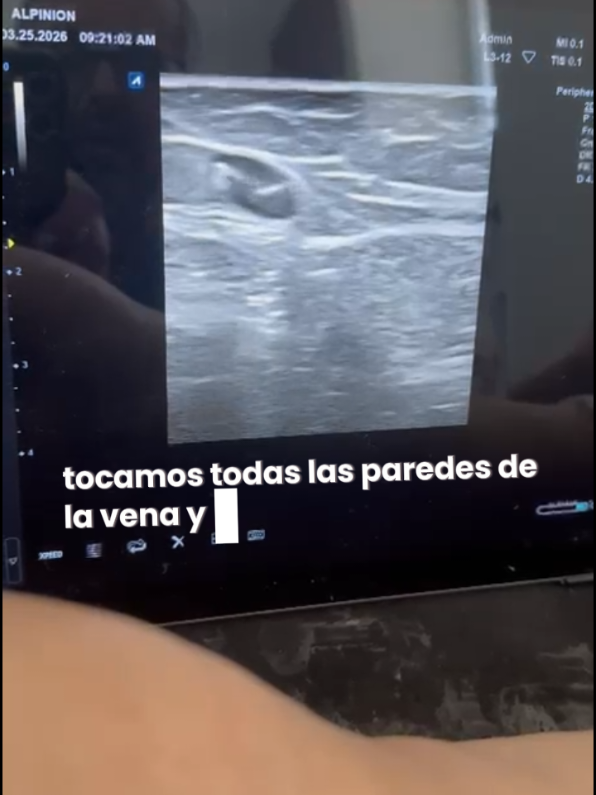 @Varices Carbonell
