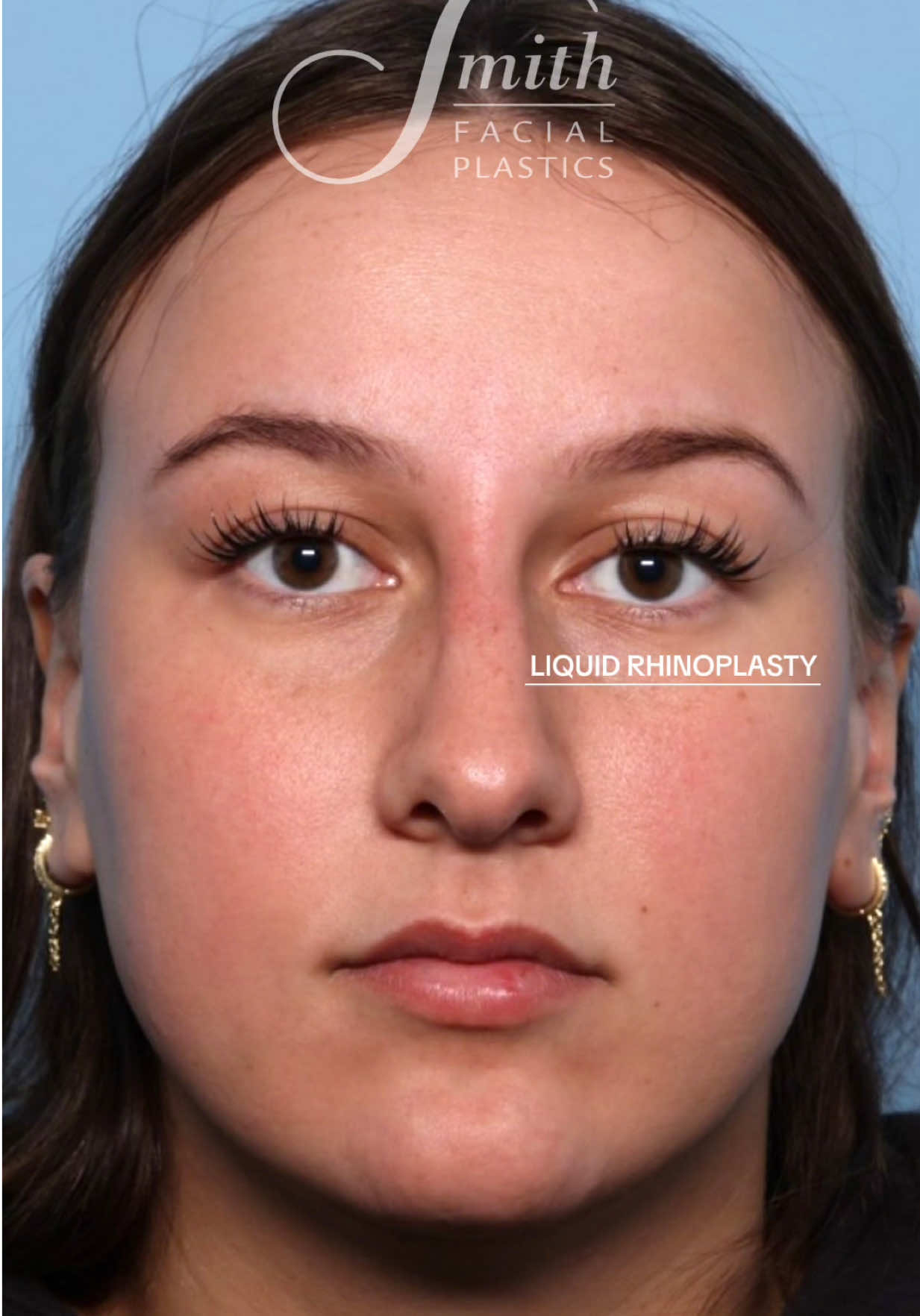 @Smith Facial Plastics