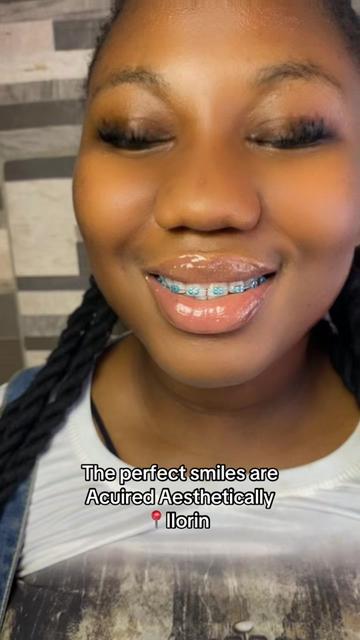 @Braces.bymavi|Smile Aesthetics