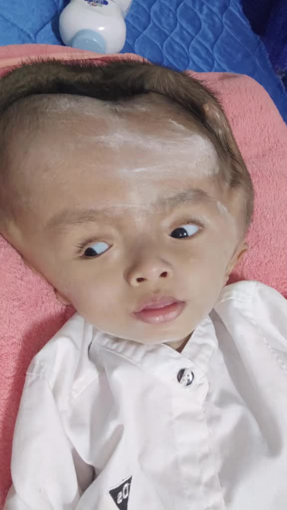 @บู้บี้เด็กหัวโตมีน้ำในโพรงสมอง