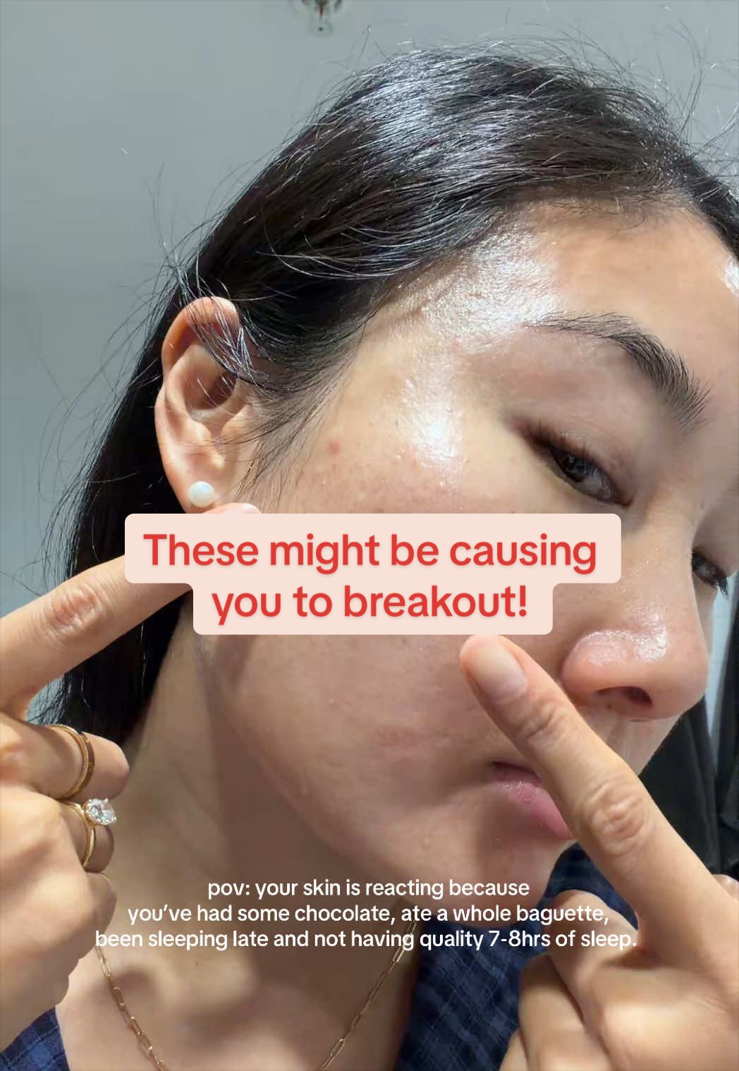 @Lisa | acne &rarr; clear skin