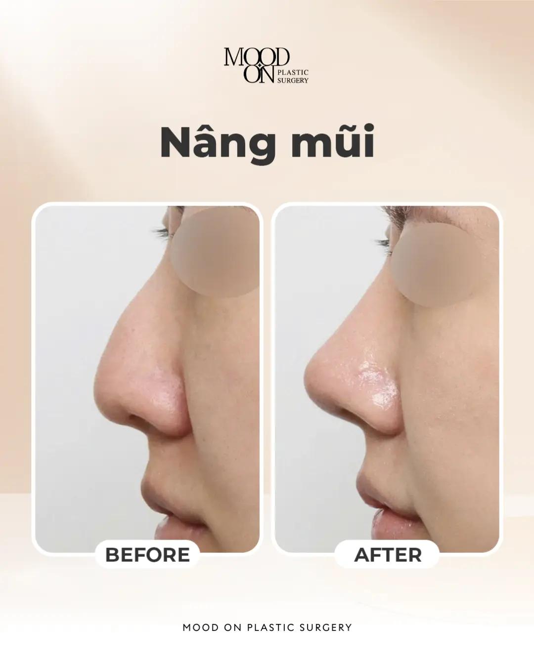 @Bệnh viện thẩm mỹ Mood On