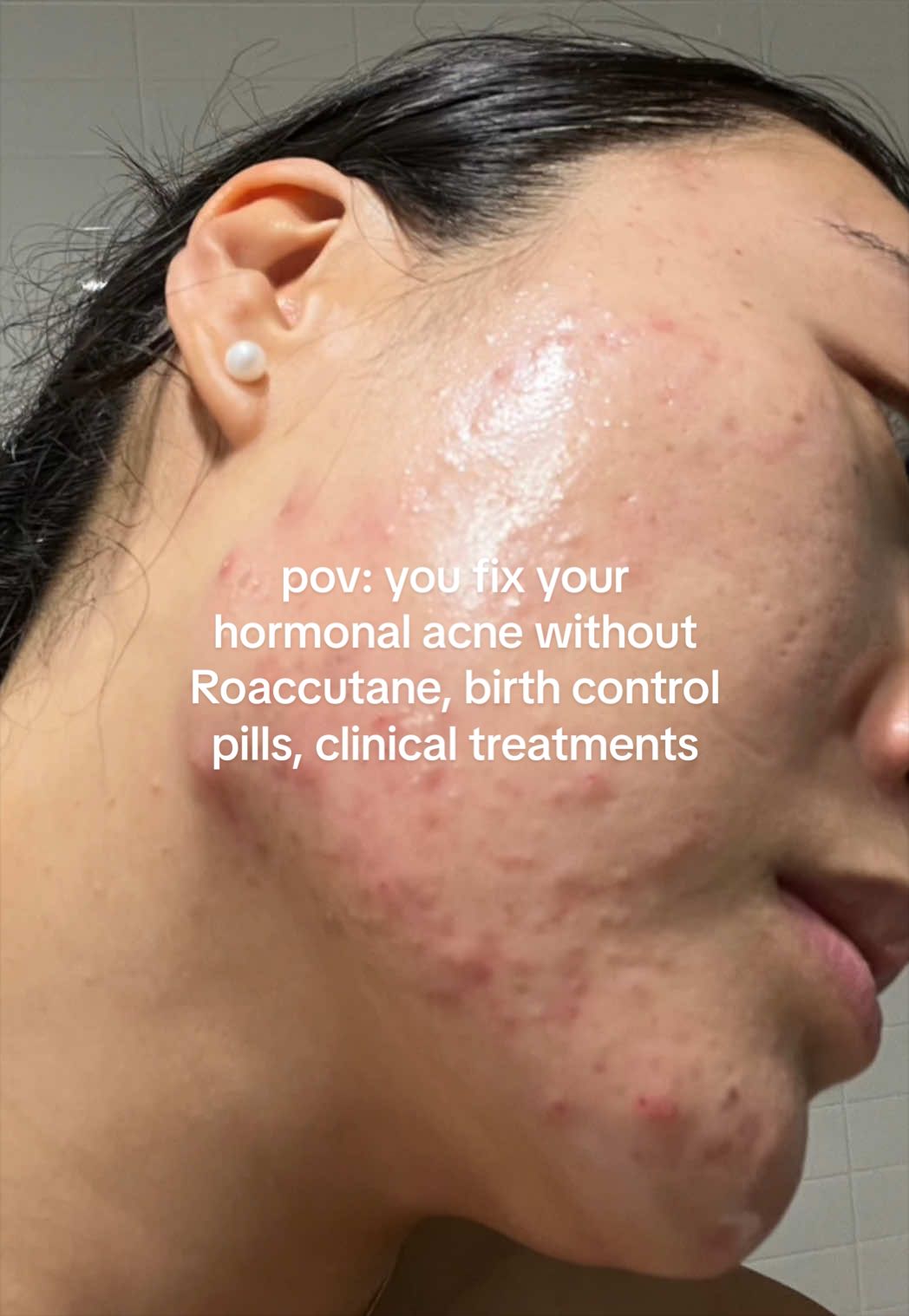 @Lisa | acne &rarr; clear skin