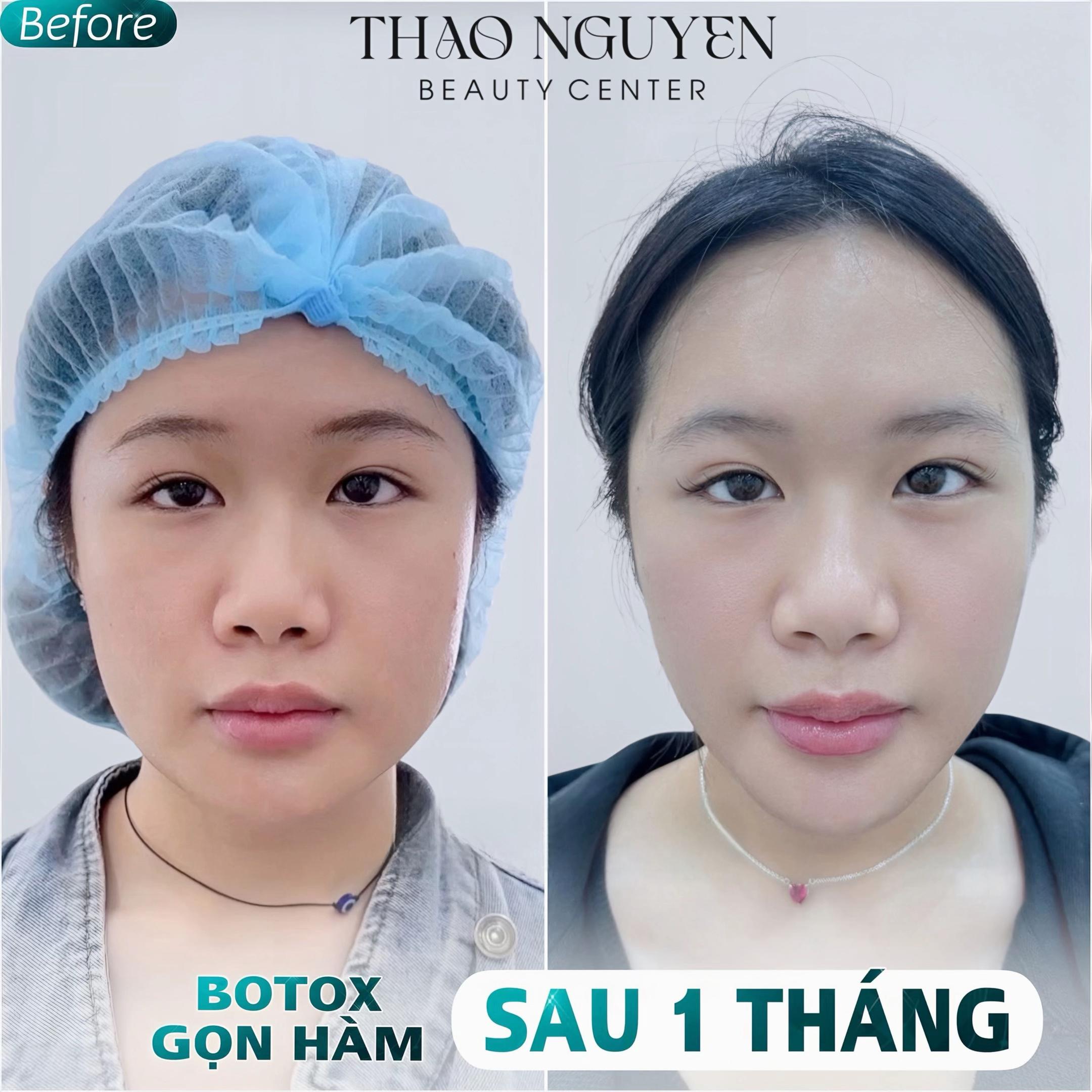 @TN - Filler Botox Đ&agrave; Nẵng