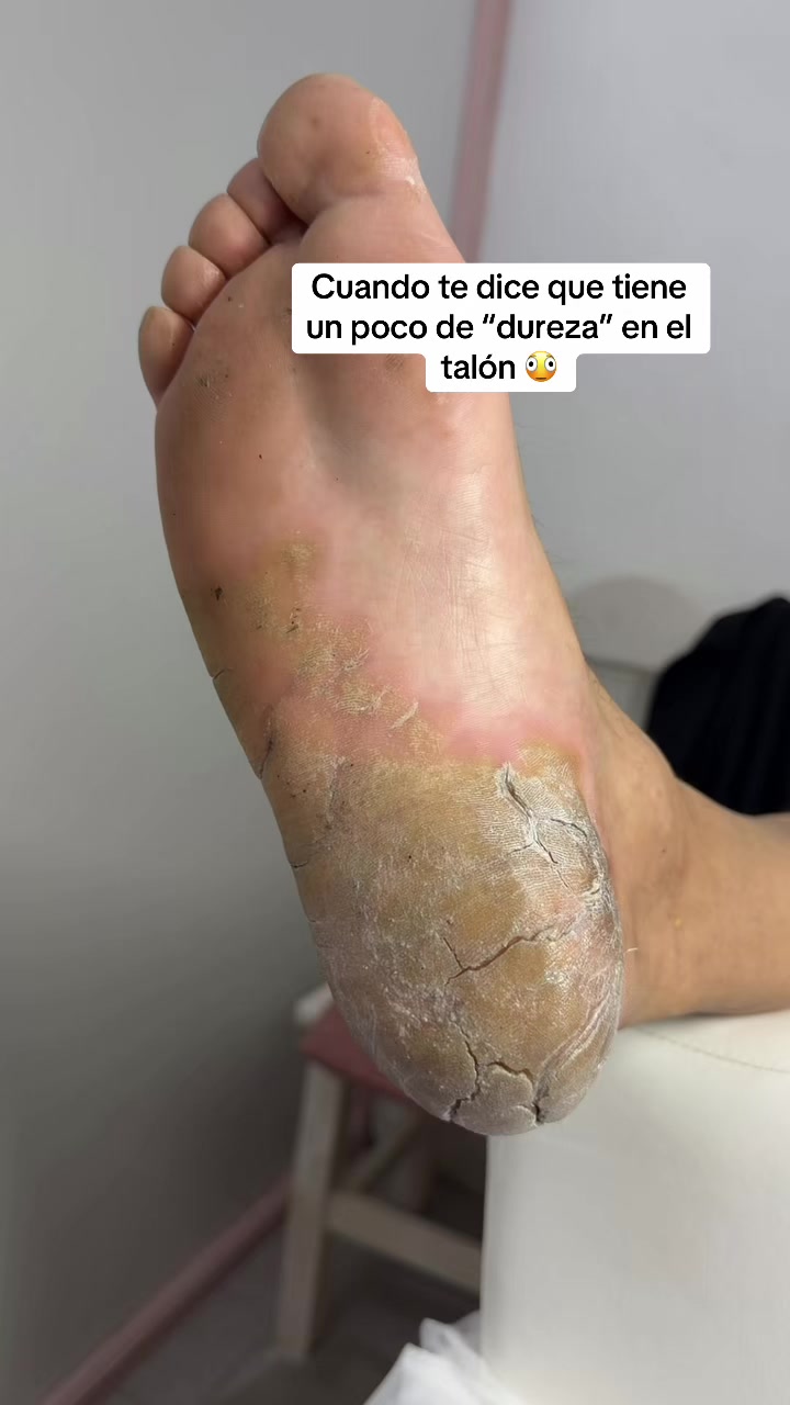@podología calzada