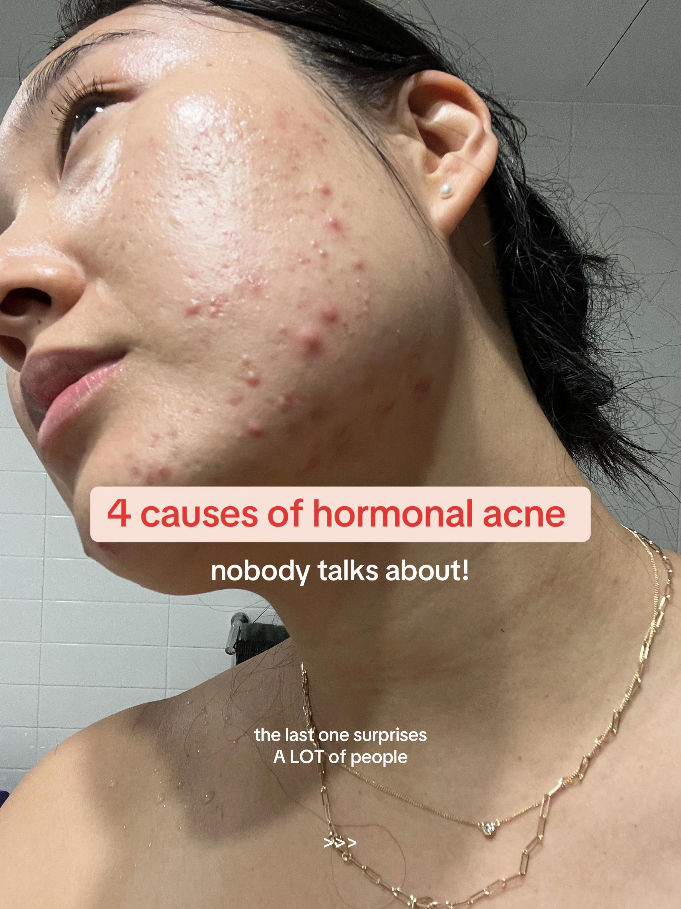 @Lisa | acne &rarr; clear skin