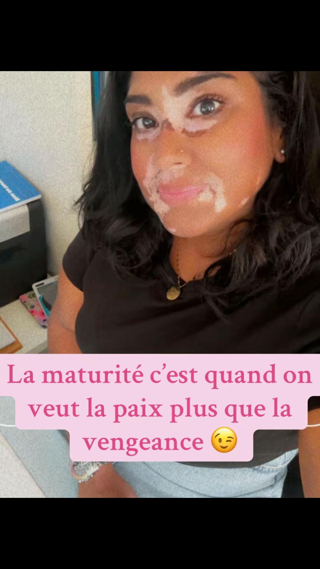 @Mimie | Vitiligo 🤍🌸