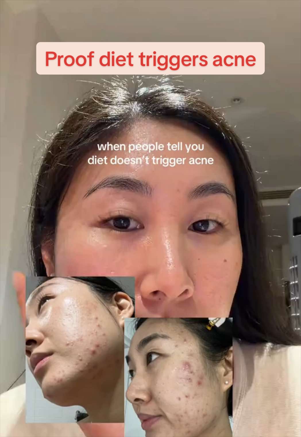 @Lisa | acne → clear skin