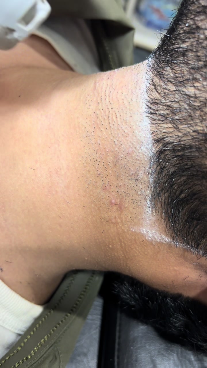@Laser Grafix clinic