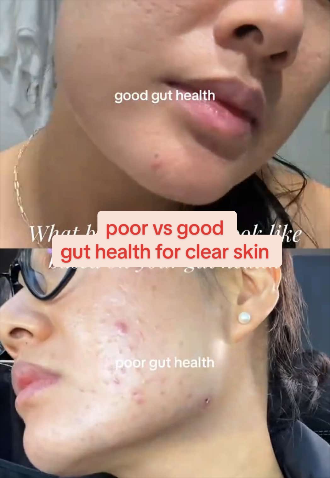 @Lisa | acne → clear skin