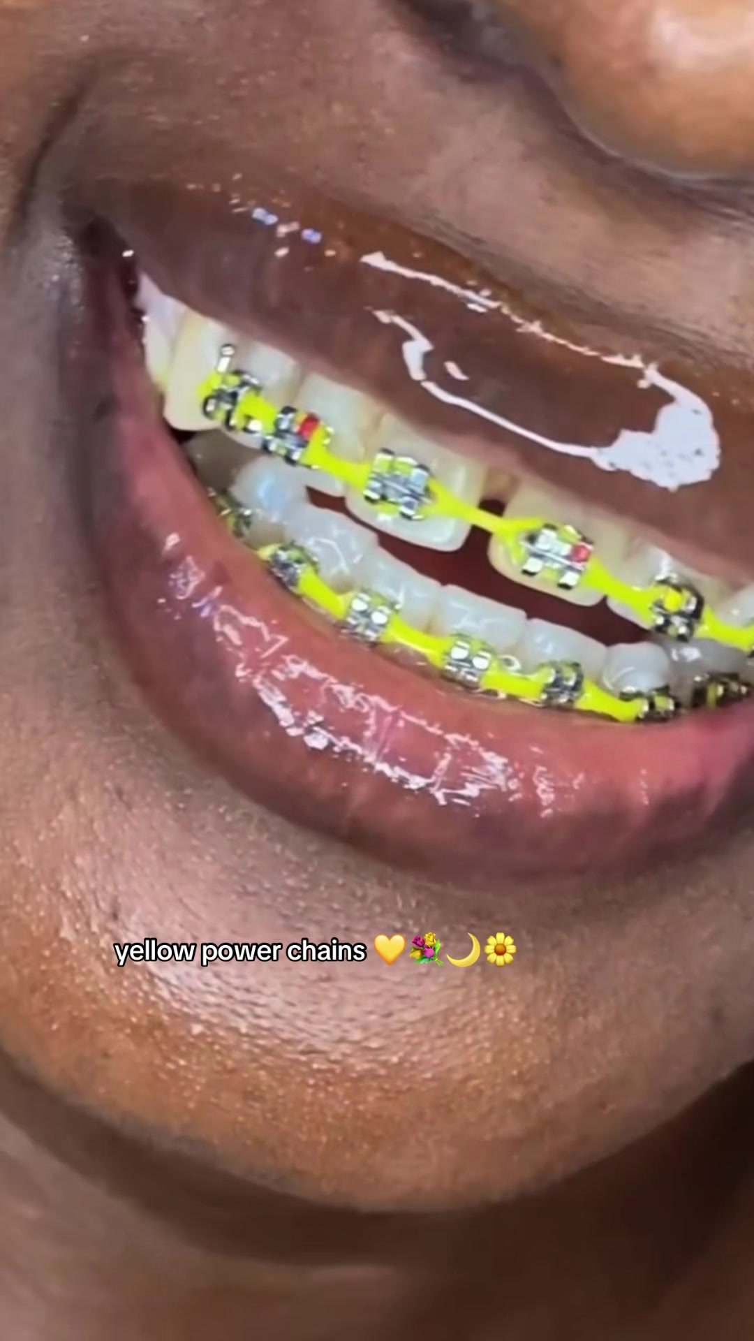 @bracesjunkie