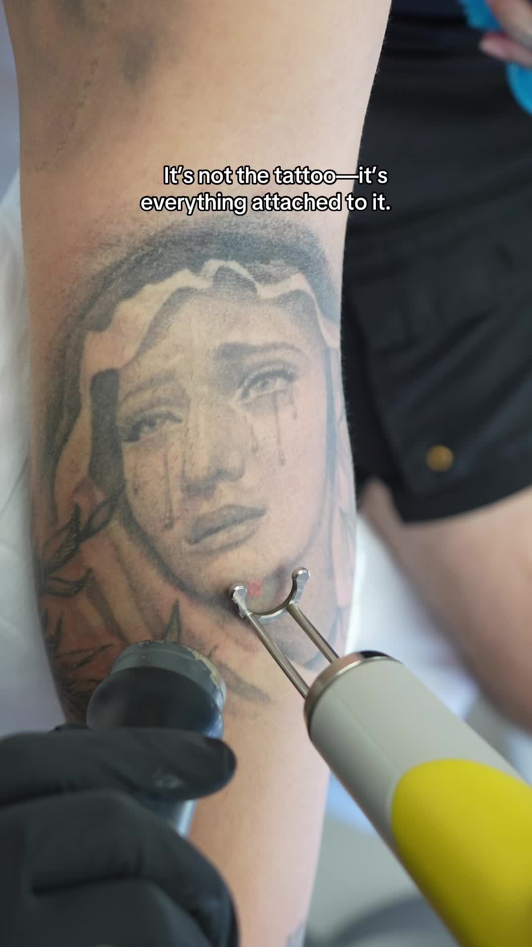 @@BHLASERTATTOOREMOVAL