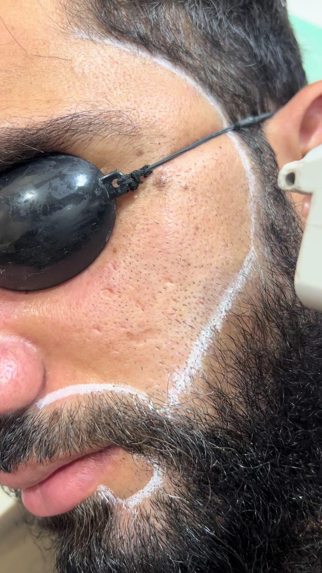 @Laser Grafix clinic