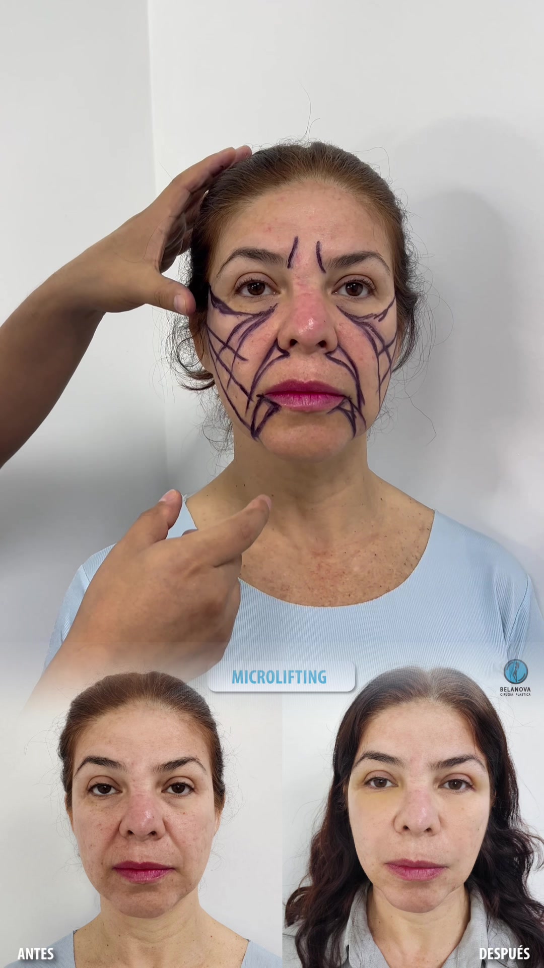 @Belanovacirugiaplastica
