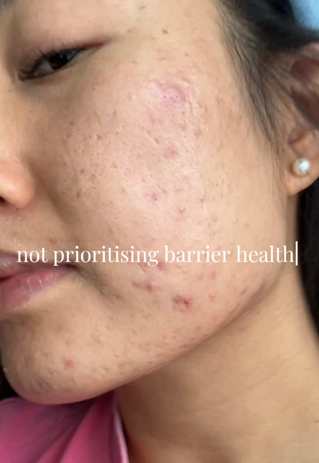 @Lisa | acne → clear skin