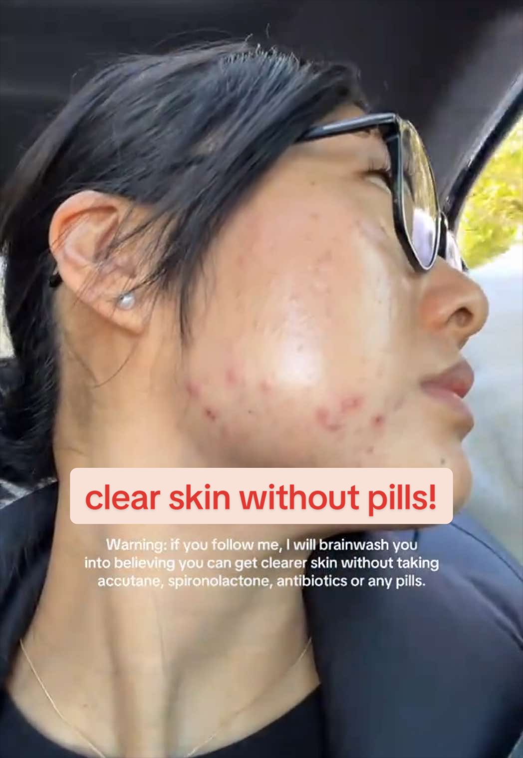 @Lisa | acne → clear skin