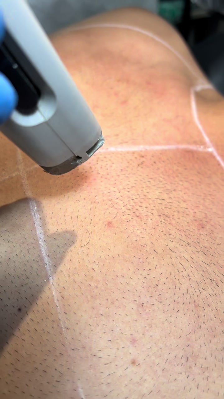 @Laser Grafix clinic