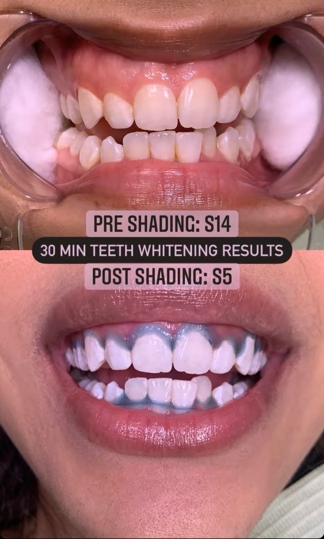 @Diandra | Teeth Whitening Tech